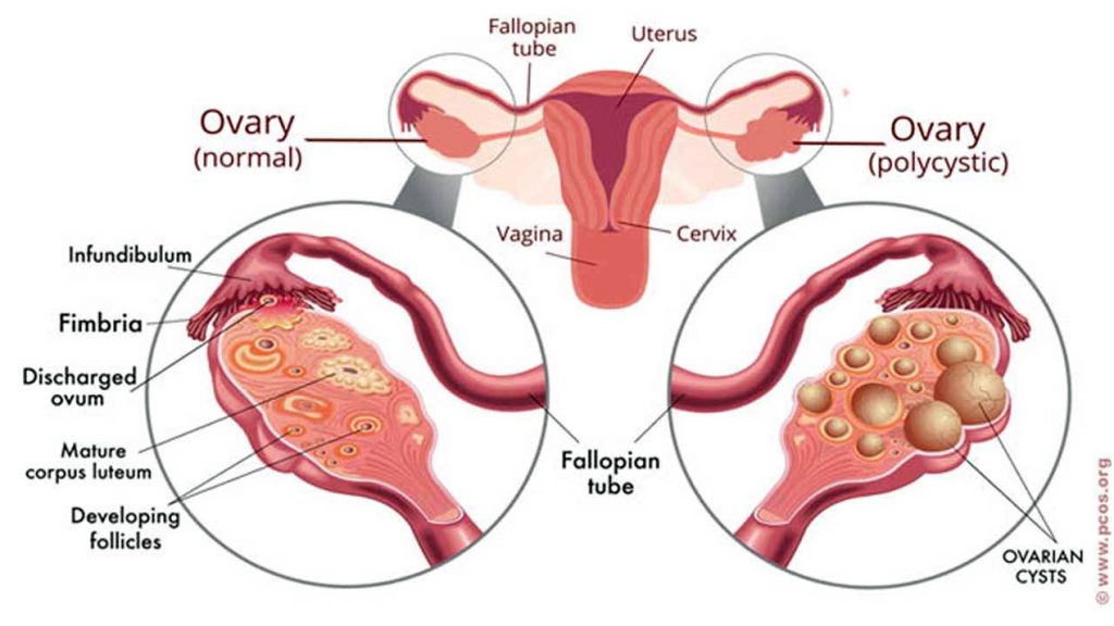 Polycystic Ovary Syndrome(PCOS)